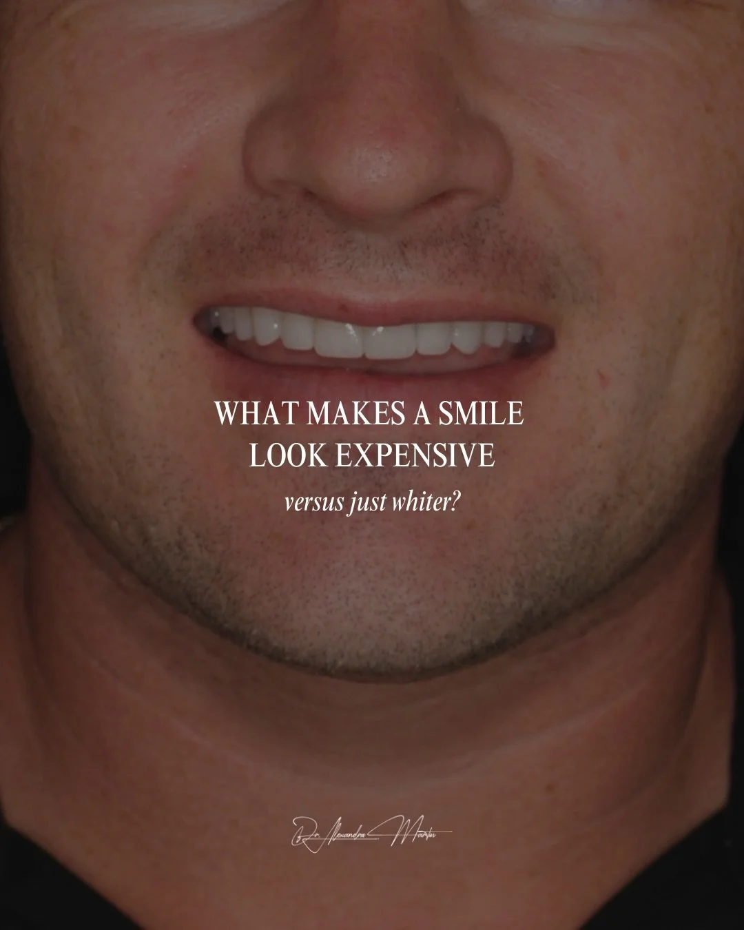 The most refined smiles are not always the whitest.

They are the ones that feel balanced, intentional, and completely at home on the person wearing them. With veneers, details like proportion, translucency, texture, and facial harmony are what make 