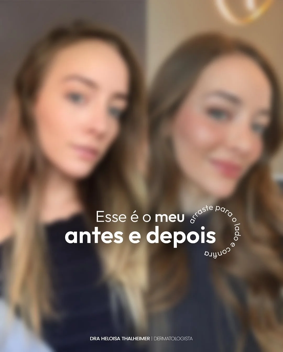 Esse antes e depois n&atilde;o &eacute; sobre mudar quem a pessoa &eacute;.
&Eacute; sobre devolver contorno, leveza, vi&ccedil;o e harmonia ao rosto, respeitando cada tra&ccedil;o e cada fase da vida.

Quando a gente combina toxina, bioestimuladores