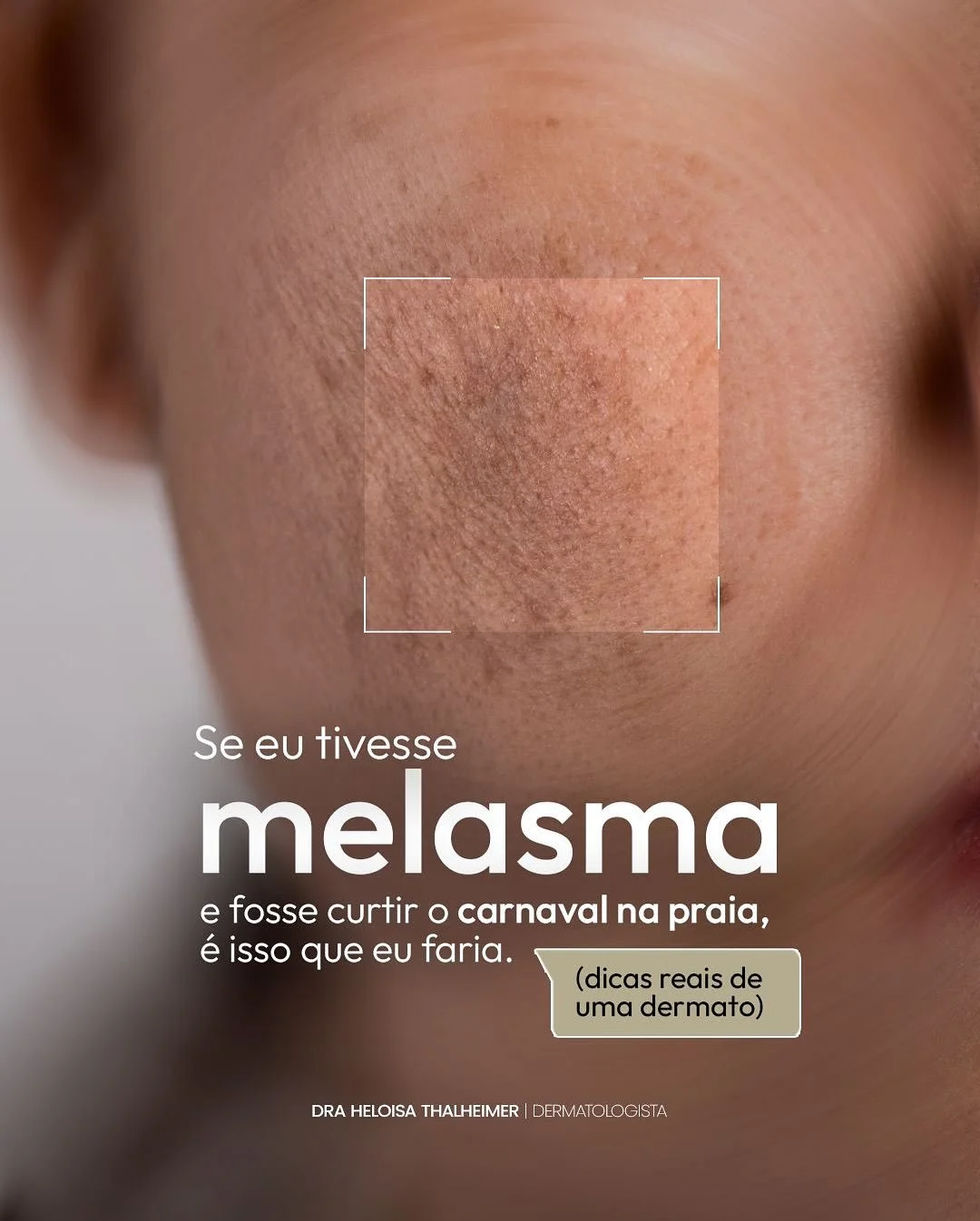 Ter melasma n&atilde;o significa abrir m&atilde;o da praia ou do carnaval.
Significa entender a sua pele e agir com intelig&ecirc;ncia.

Com prote&ccedil;&atilde;o correta, bons hor&aacute;rios e cuidados simples,
&eacute; poss&iacute;vel curtir sem 