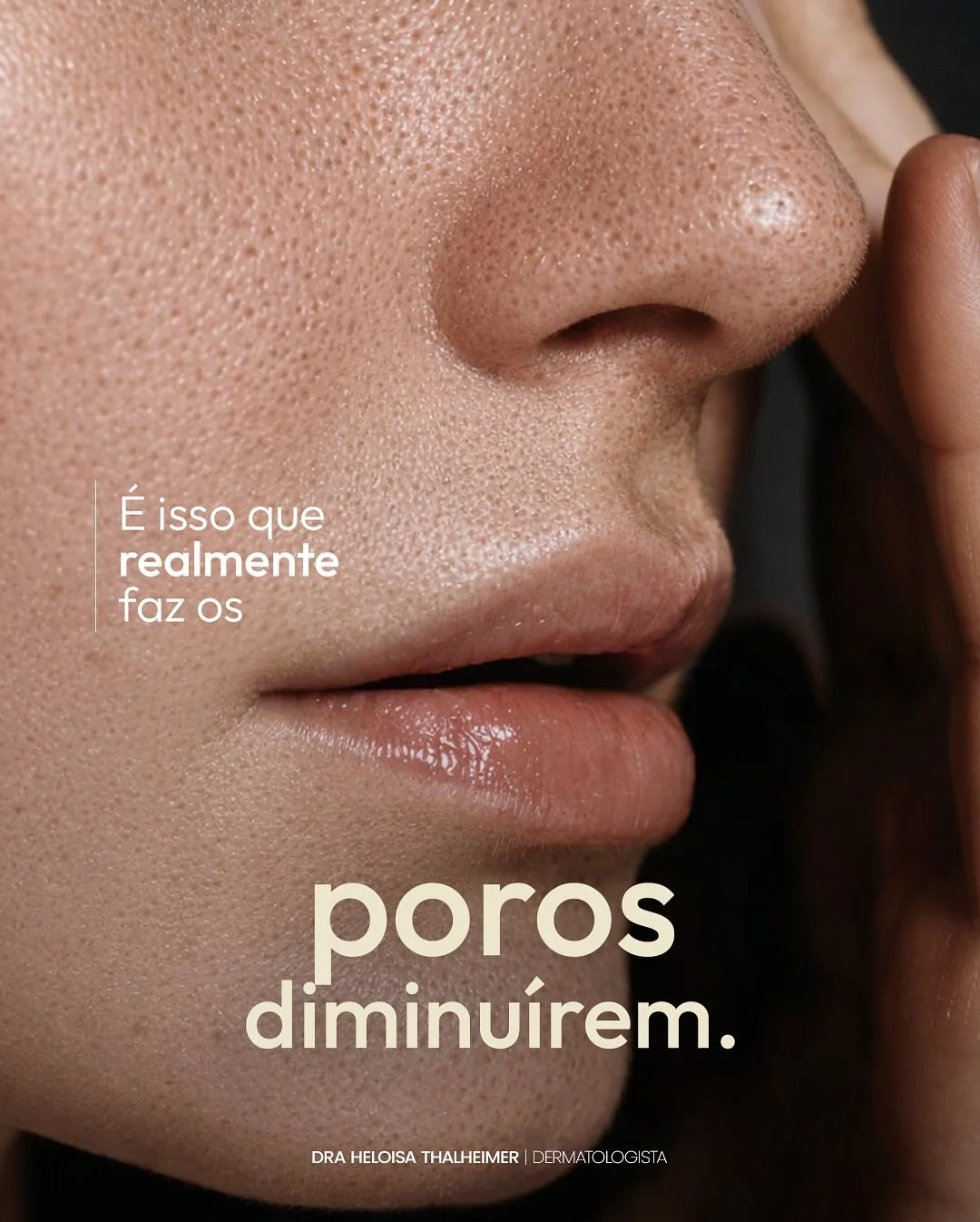 Poros n&atilde;o &ldquo;abrem&rdquo; nem &ldquo;fecham&rdquo;. O que acontece &eacute; que, ao longo do tempo, a pele muda: produz mais oleosidade, inflama, perde col&aacute;geno e textura.
Quando a gente trata essas causas, a pele fica mais uniforme