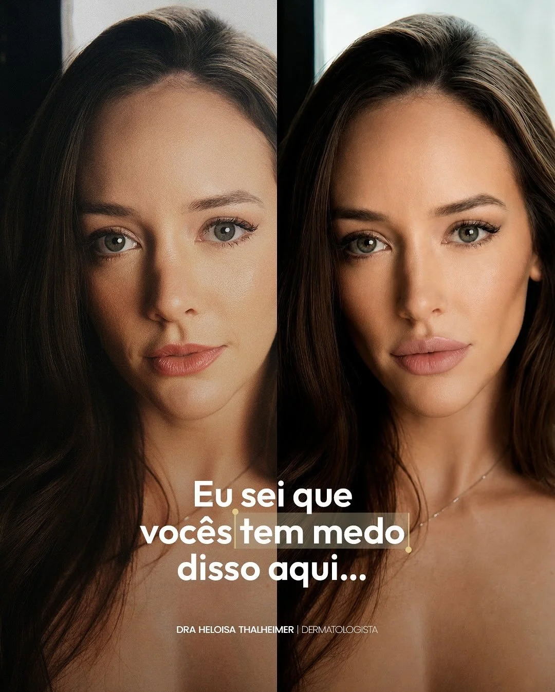 Voc&ecirc; n&atilde;o precisa sair do consult&oacute;rio com outro rosto para se sentir mais bonita.

Procedimento bem feito n&atilde;o muda quem voc&ecirc; &eacute;. Ele respeita a sua anatomia, a sua express&atilde;o e a sua ess&ecirc;ncia.

O prob
