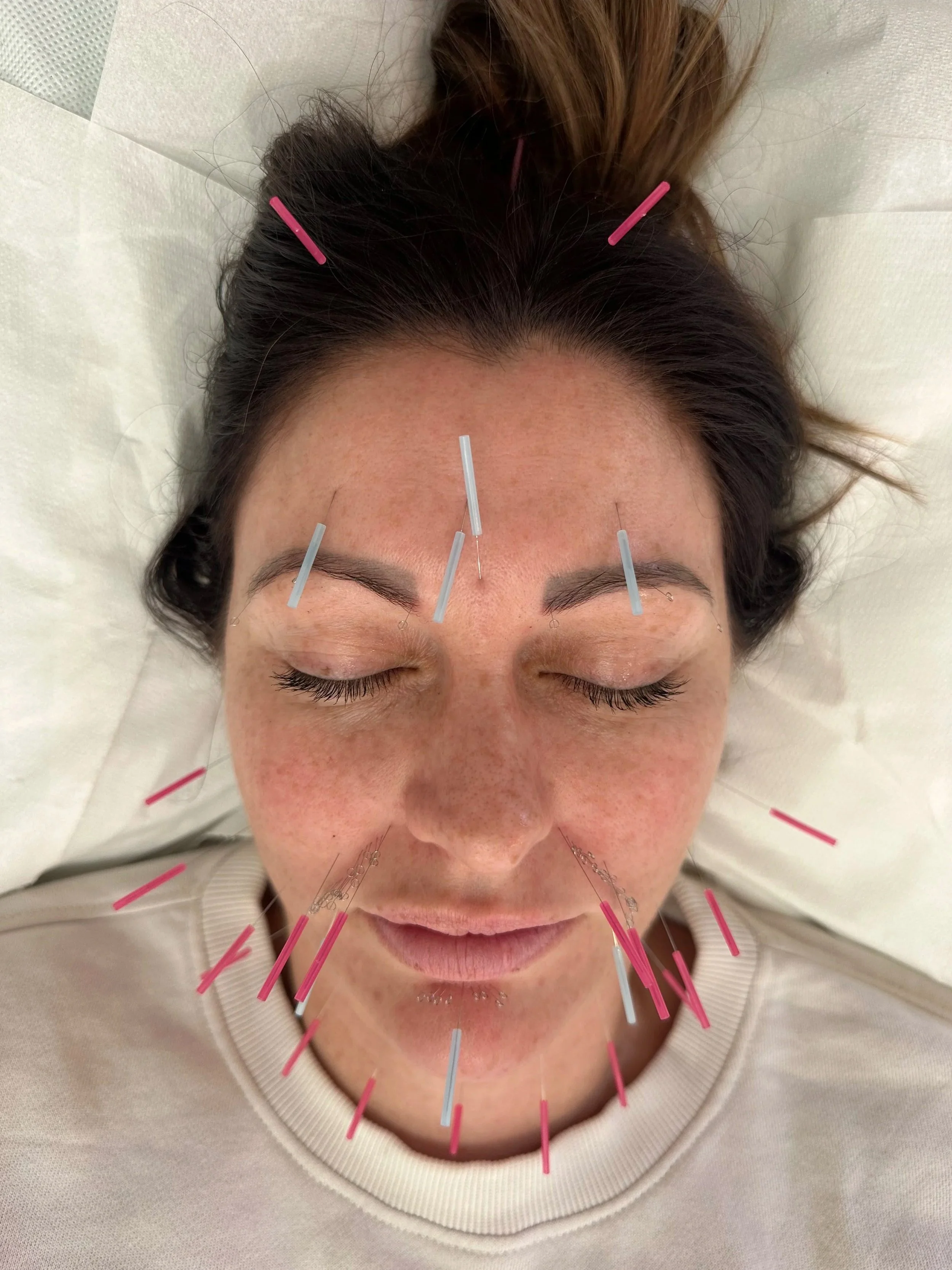 A woman lying down in an acupuncture clinic in Highgate, London, with acupuncture needles inserted in her face and chin area, receiving a cosmetic acupuncture treatment from a licensed acupuncture provider