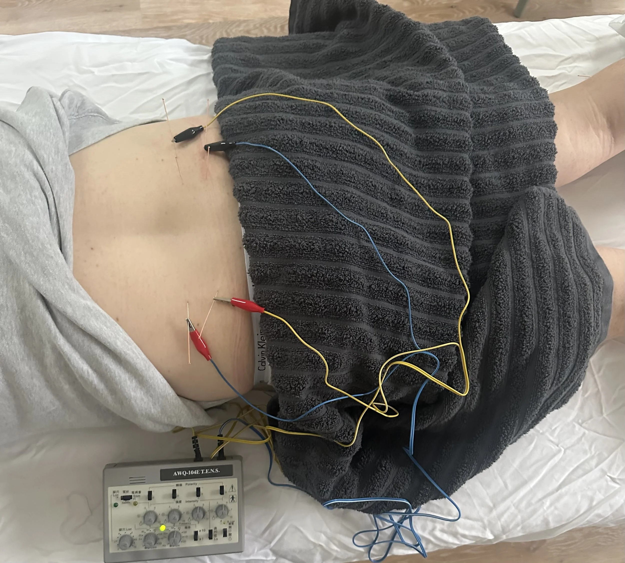 A person lying on an acupuncture treatment bed in a clinic near Crouch End, receiving electro-acupuncture to help with lower back pain and stress