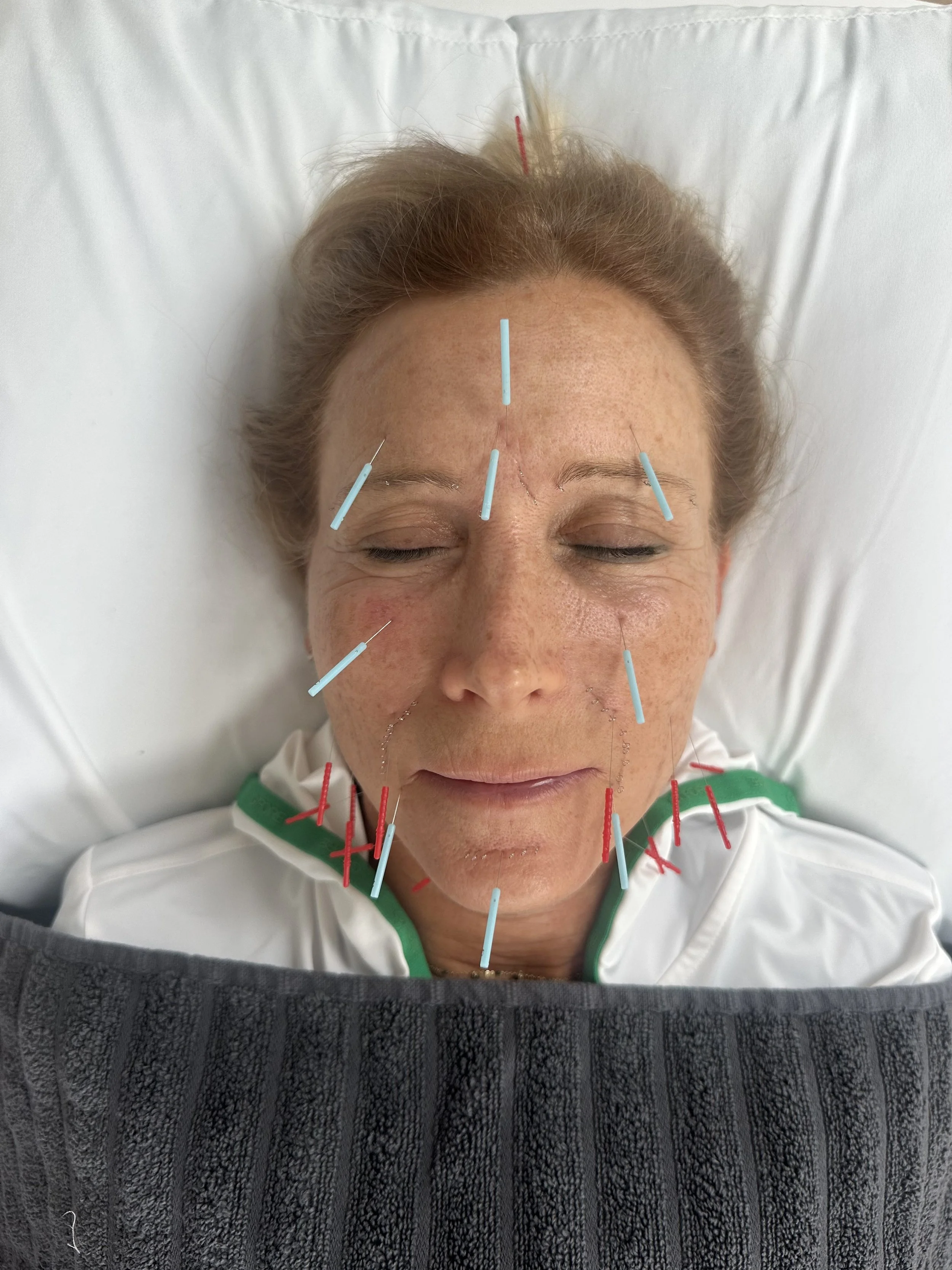 Close-up of a woman with closed eyes, relaxing on a pillow, receiving facial acupuncture treatment with multiple needles inserted on her face and neck to improve fine lines without botox
