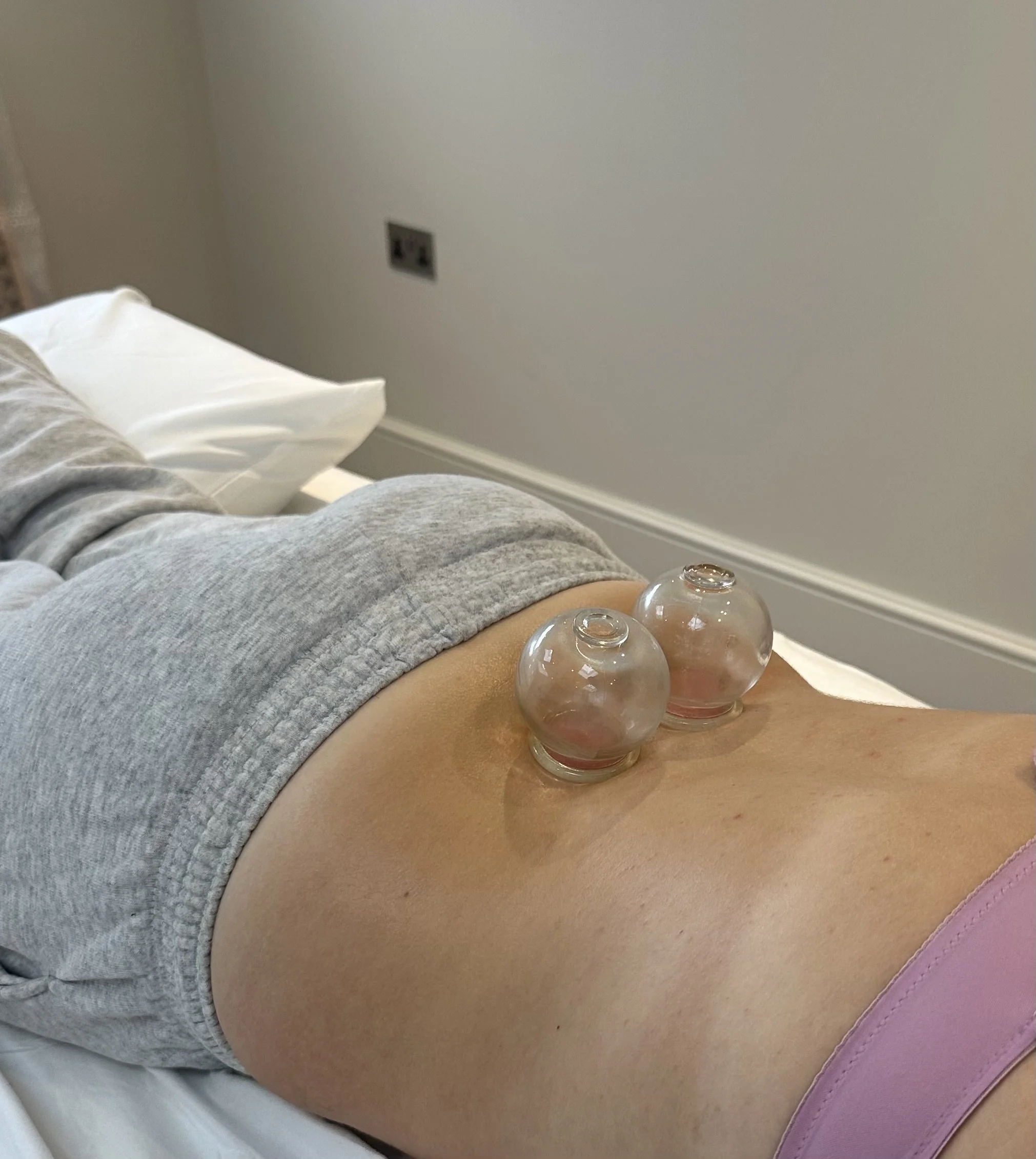 A person lying on an acupuncture bed with two glass cupping therapy cups placed on their abdomen to help with menstrual pain and irregular periods.