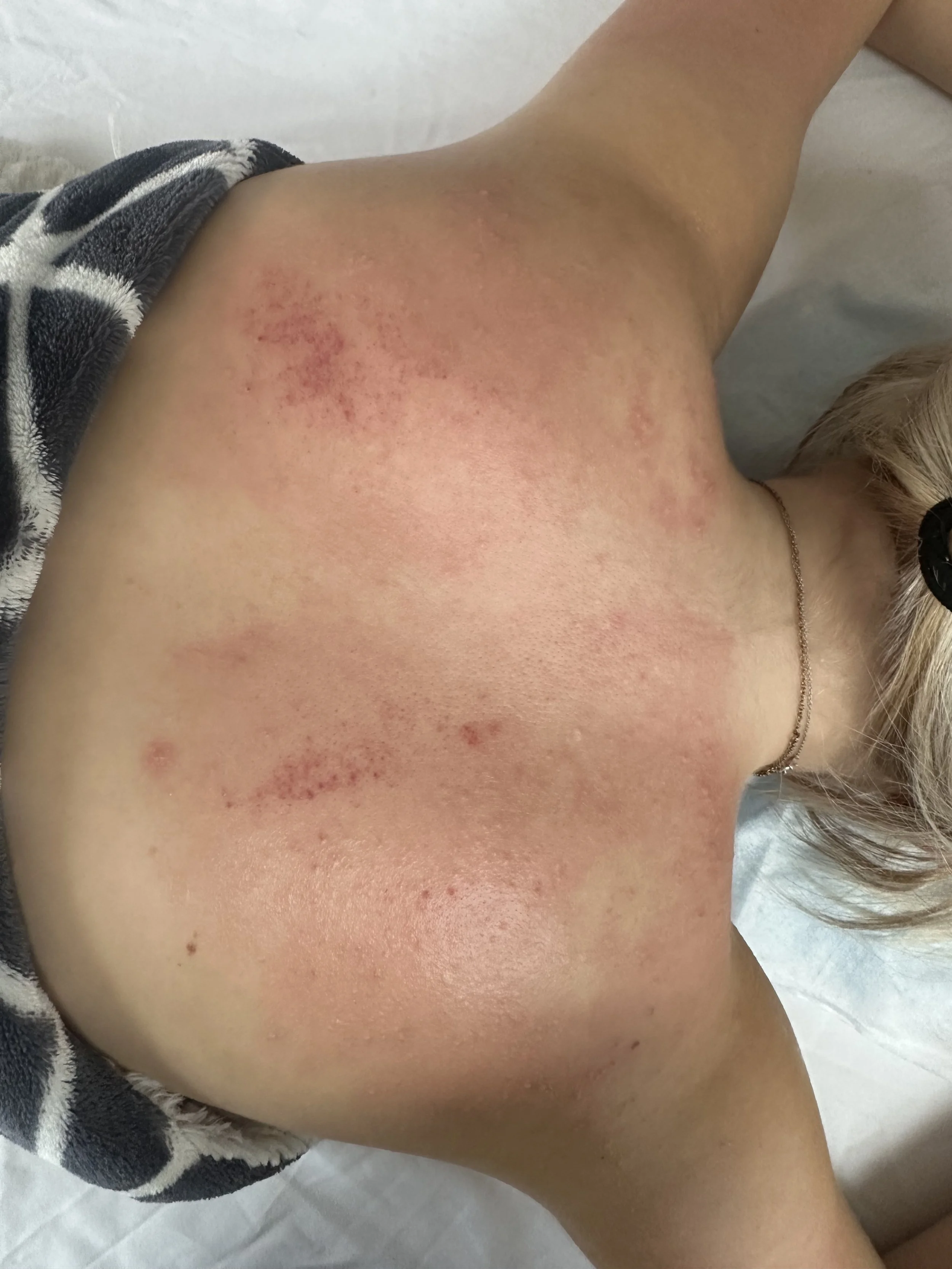 Close-up of a person's back showing gua sha marks to help with a common cold and flu like symptoms