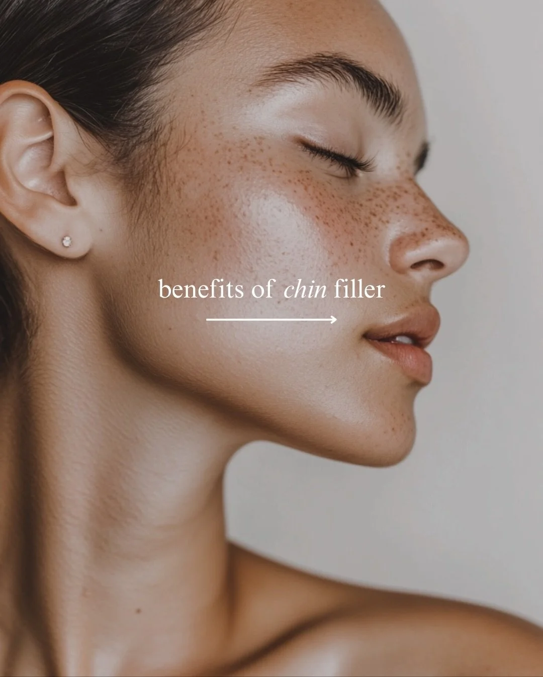 Sculpted. Balanced. Confident.
Chin filler is one of the most underrated ways to transform your entire profile &mdash; and the results speak for themselves. 💬✨

By enhancing projection, sharpening contour, and restoring harmony to your facial propor
