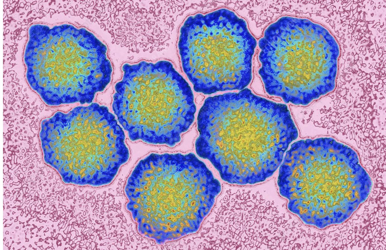 Colorized illustration of multiple herpes simplex virus particles, round with textured surface, blue and yellow, on a pink background.