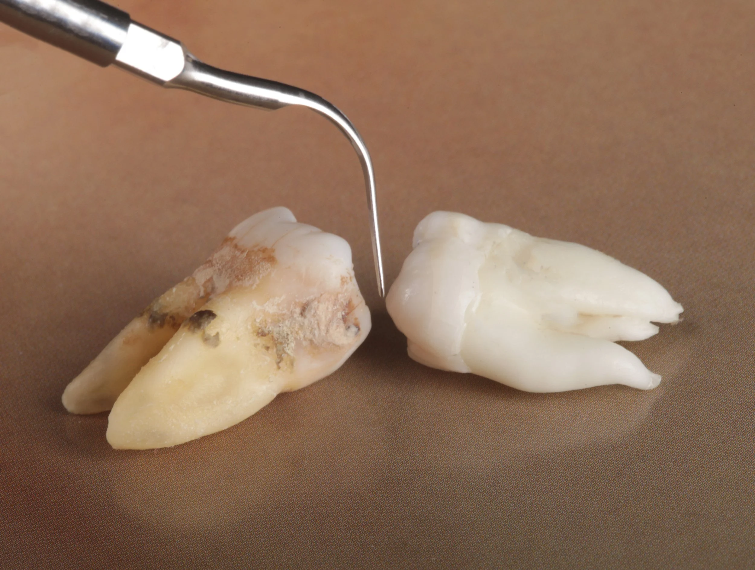 Two extracted human molar teeth, one with caries and debris, and a dental scaler tool above them.