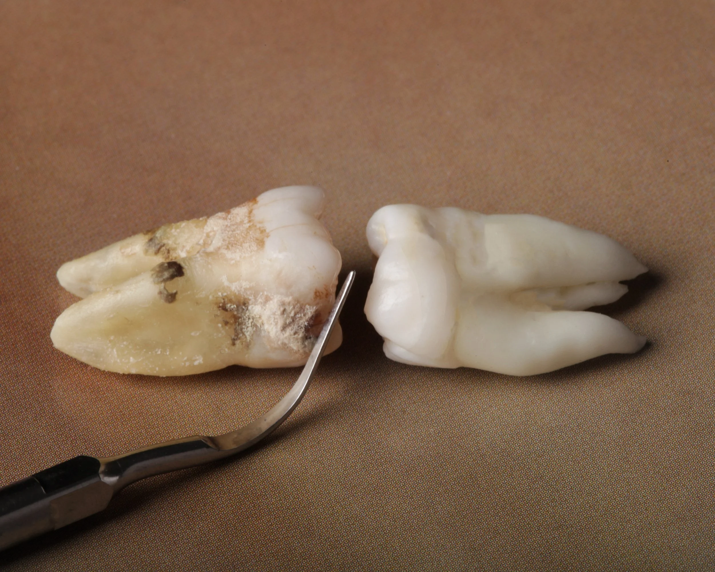 Two extracted human molar teeth, one with decay and a dental tool nearby.
