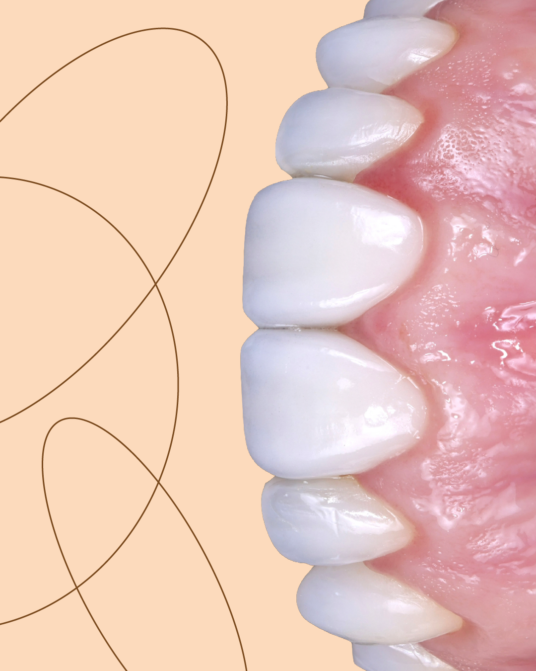 Close-up view of a set of upper front teeth with dental veneers or crowns, showing a healthy and bright smile.