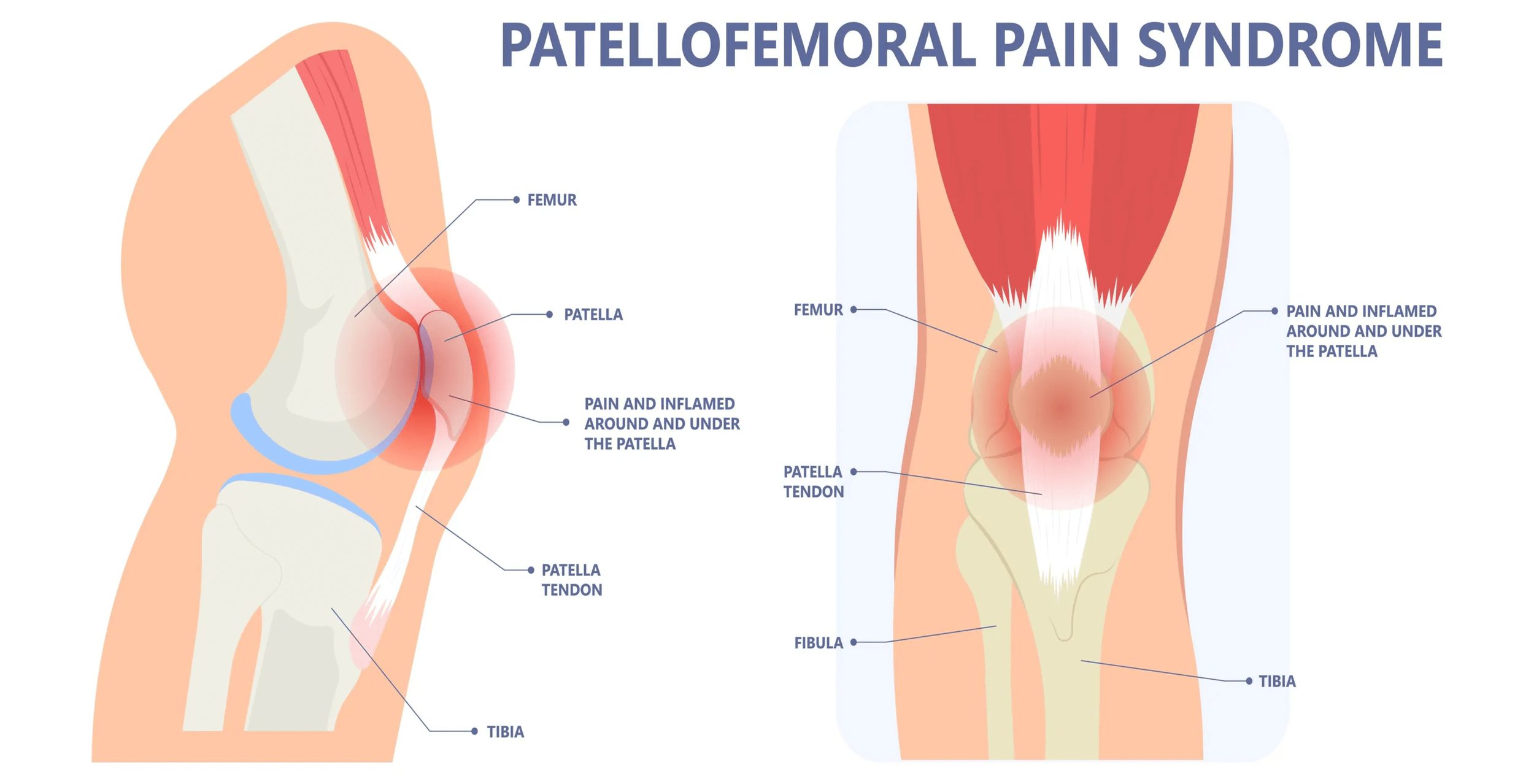 Patellofemoral pain syndrome rehab for kalamazoo runners