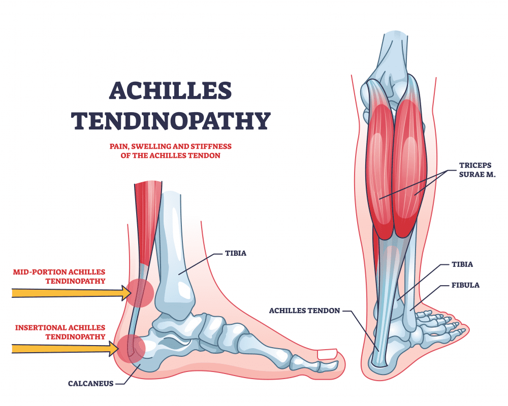 Resolve achilles tendon pain for runners in Kalamazoo, MI.