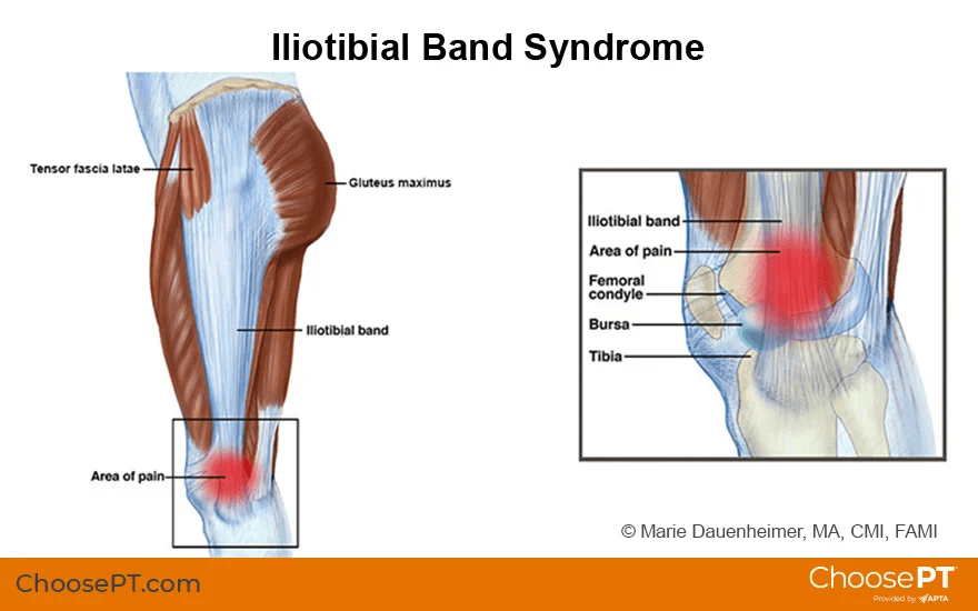 Pure Movement physical therapy treats IT band syndrome in Kalamazoo runners.