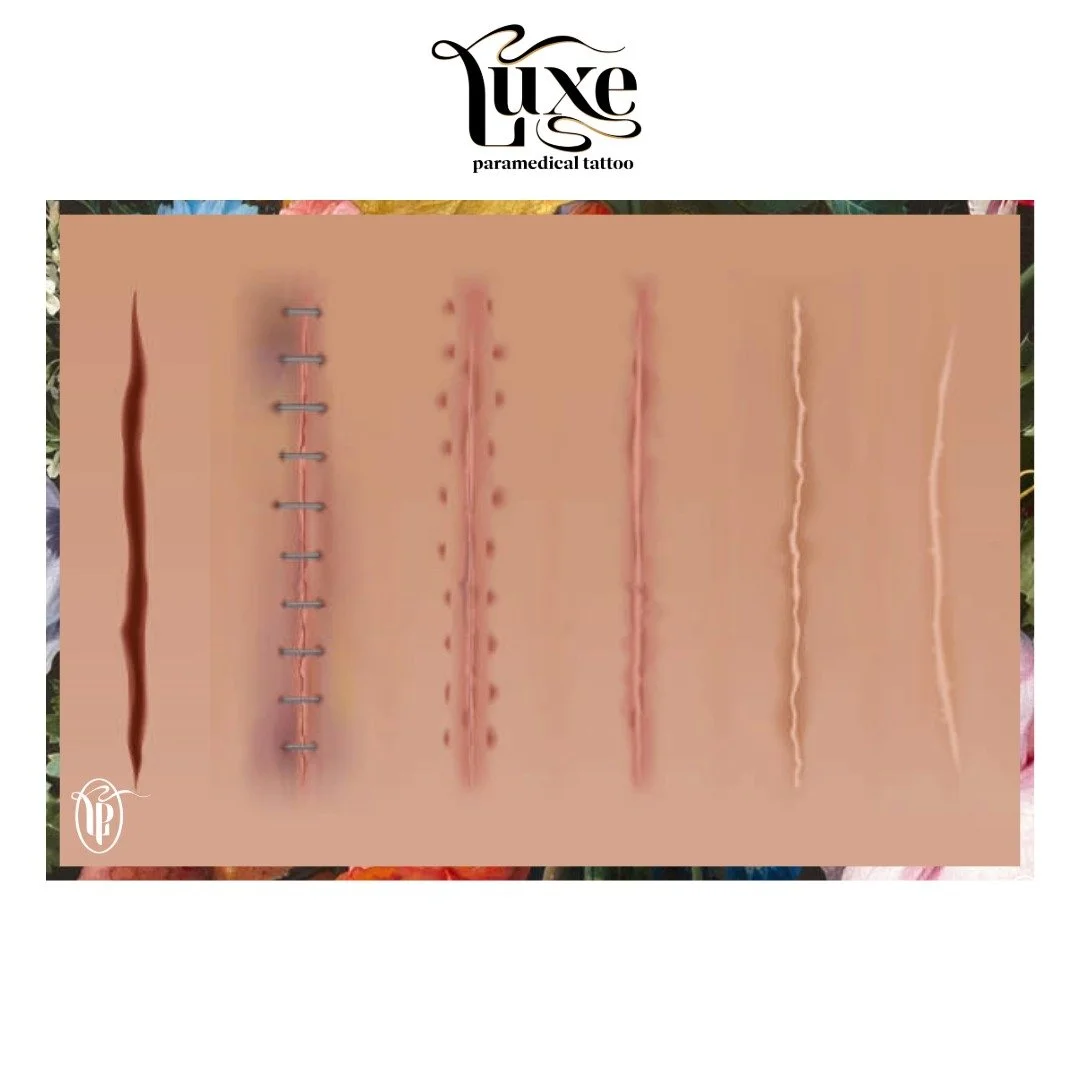 Scars go through stages&mdash;and knowing what&rsquo;s happening under the skin can help you care for them the right way.

Inflammatory Stage (Days 0&ndash;6)
Your body is protecting itself, which means swelling, redness, and tenderness. Keep the are
