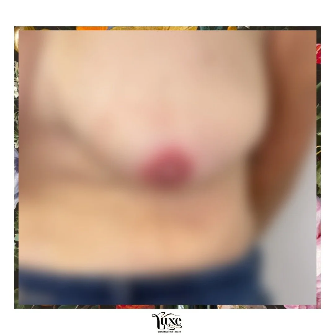 BREAST CANCER_POST MASTECTOMY_
IMAGE OF MEDICAL TATTOO _3D NIPPLE / AREOLA TATTOO

My beautiful client had a bilateral mastectomy on one side, followed by reconstructive surgery. Unfortunately, the nipple reconstruction wasn&rsquo;t a success.

She w