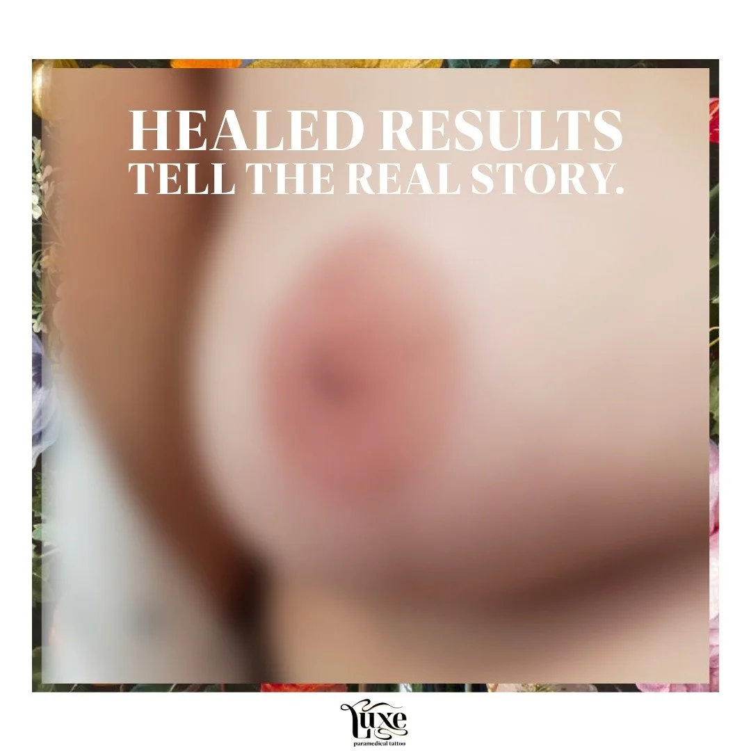 BREAST CANCER_POST MASTECTOMY_
IMAGE OF MEDICAL TATTOO _3D NIPPLE / AREOLA TATTOO

Healed results tell the real story.

Fresh tattoos can look bold, crisp, and even a little too perfect. Right after treatment, the skin is red, raised, and pigments ar