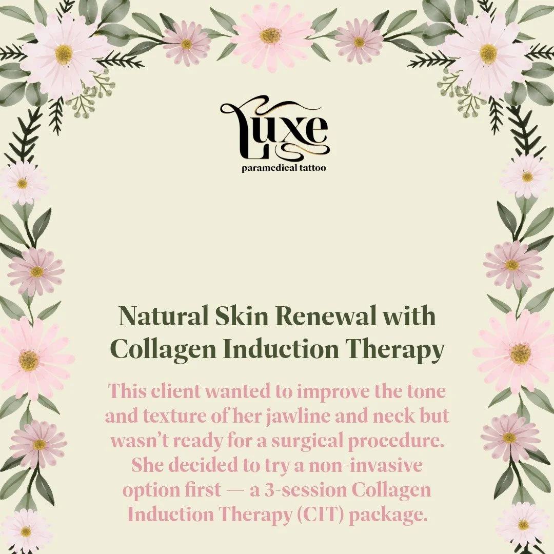 This client wanted to improve the tone and texture of her jawline and neck but wasn&rsquo;t ready for a surgical procedure. She decided to try a non-invasive option first &mdash; a 3-session Collagen Induction Therapy (CIT) package.

CIT works by sti
