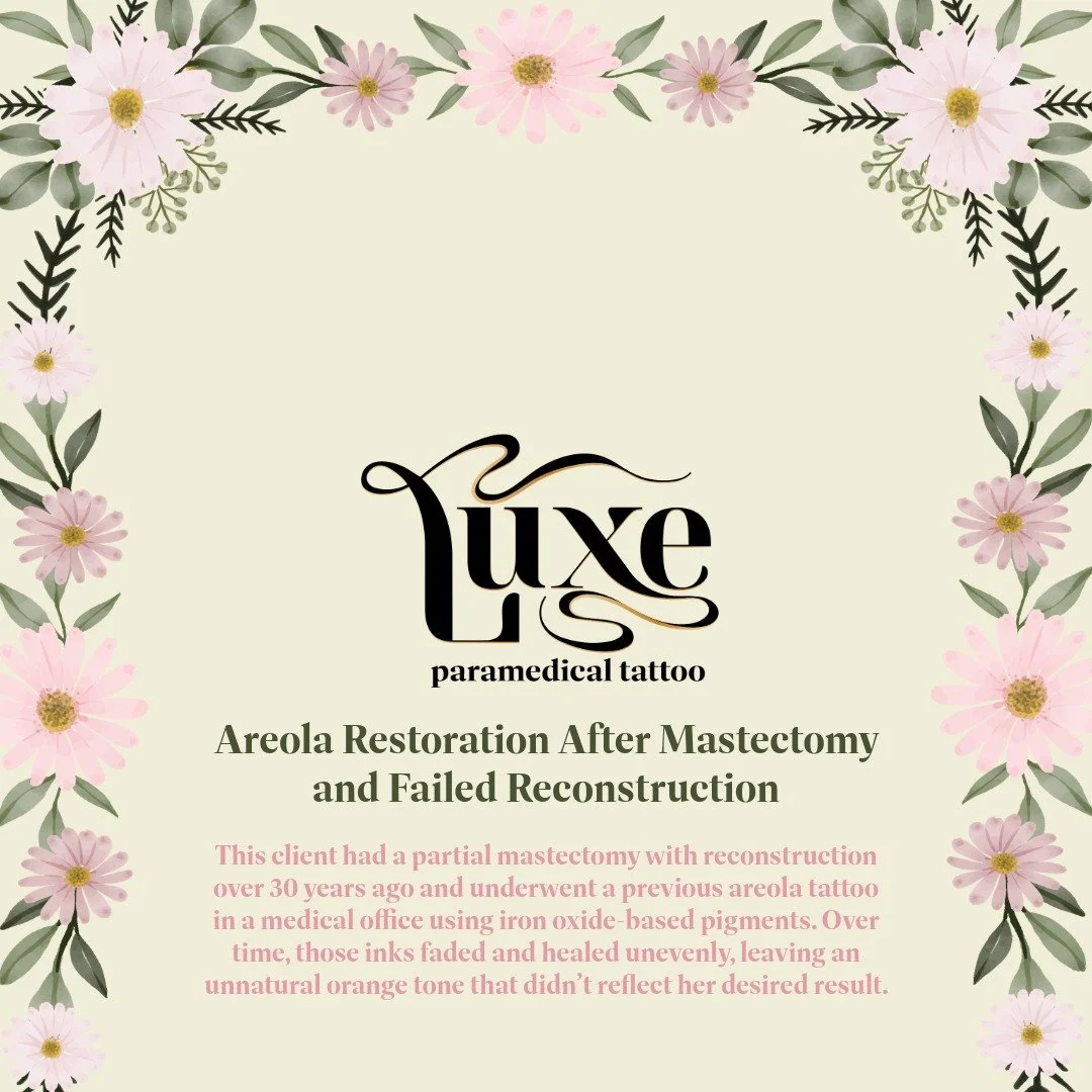 This client had a partial mastectomy with reconstruction over 30 years ago and underwent a previous areola tattoo in a medical office using iron oxide-based pigments. Over time, those inks faded and healed unevenly, leaving an unnatural orange tone t