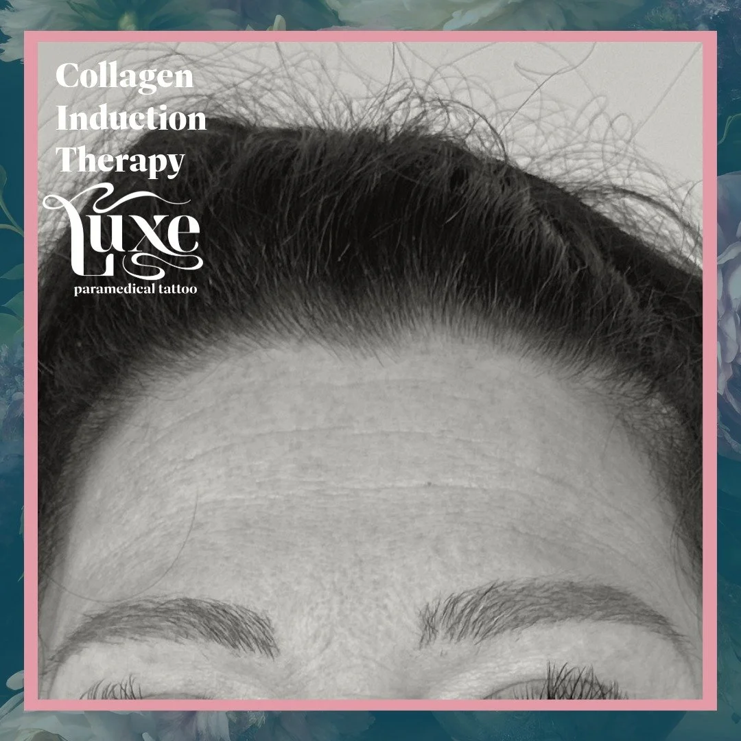 This client wanted to improve the appearance of fine lines on her forehead but didn&rsquo;t feel comfortable using injectables like Botox or fillers.

Instead, we used Collagen Induction Therapy (C.I.T.) paired with hyaluronic acid serum to stimulate