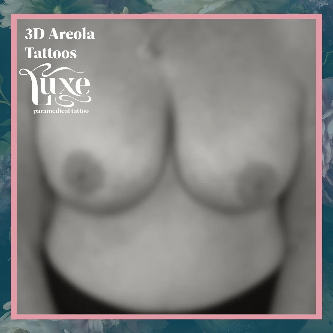This client had a breast lift and augmentation that left light scarring and a loss of natural pigment in the areola area. She wanted a conservative approach to restore color without changing her natural shape or size.

In this first session, we focus