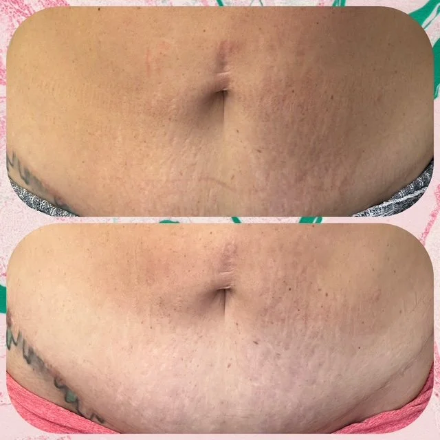 Inkless Stretch Mark and Scar Treatment: How MCA Needling and CIT Work and What to Expect