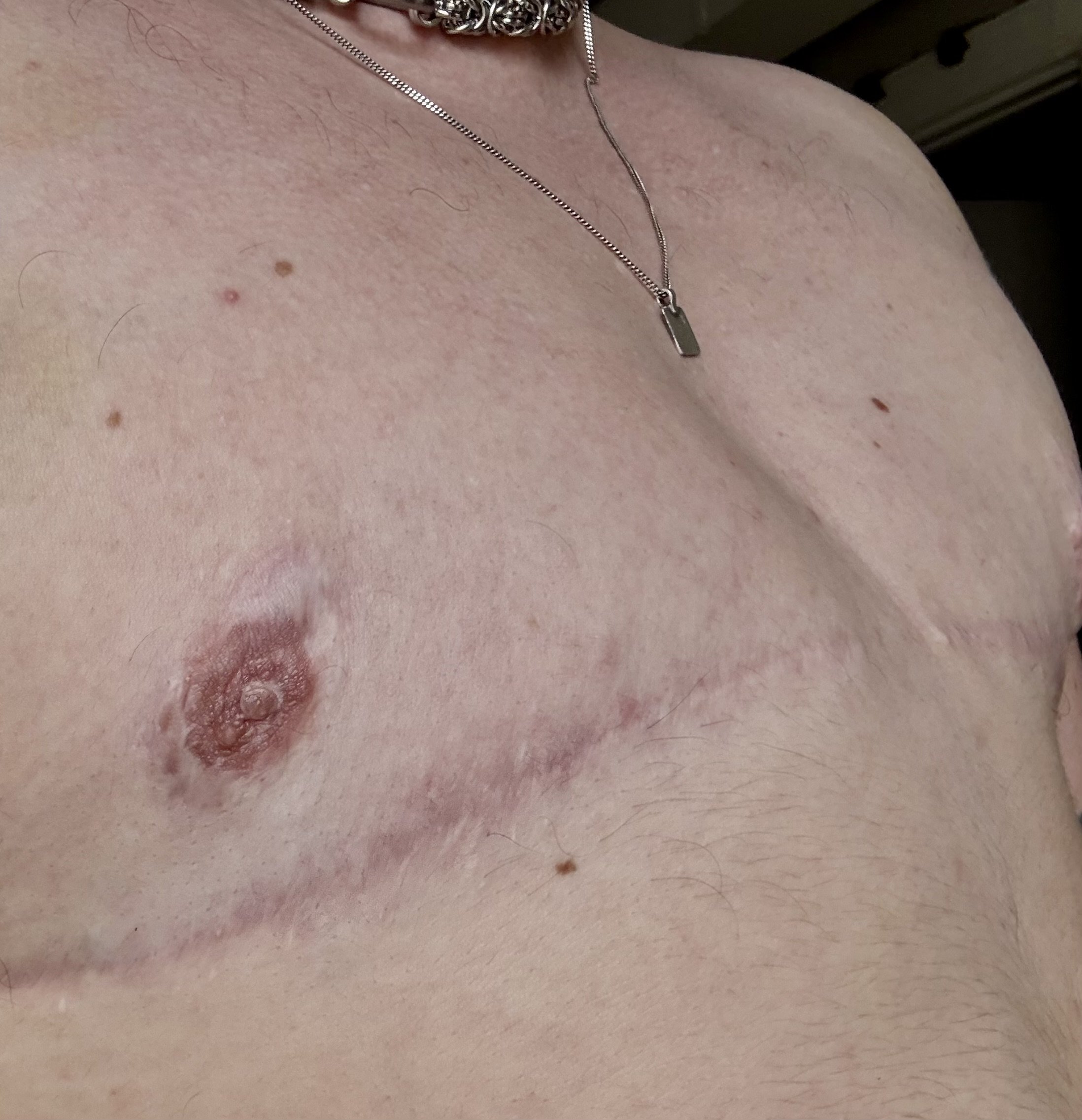 Gender-Affirming and Trauma-Informed Scar Camouflage Care in Pittsburgh