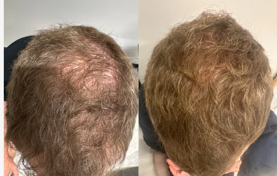 After 2 TED with TED Proprietary Serum
