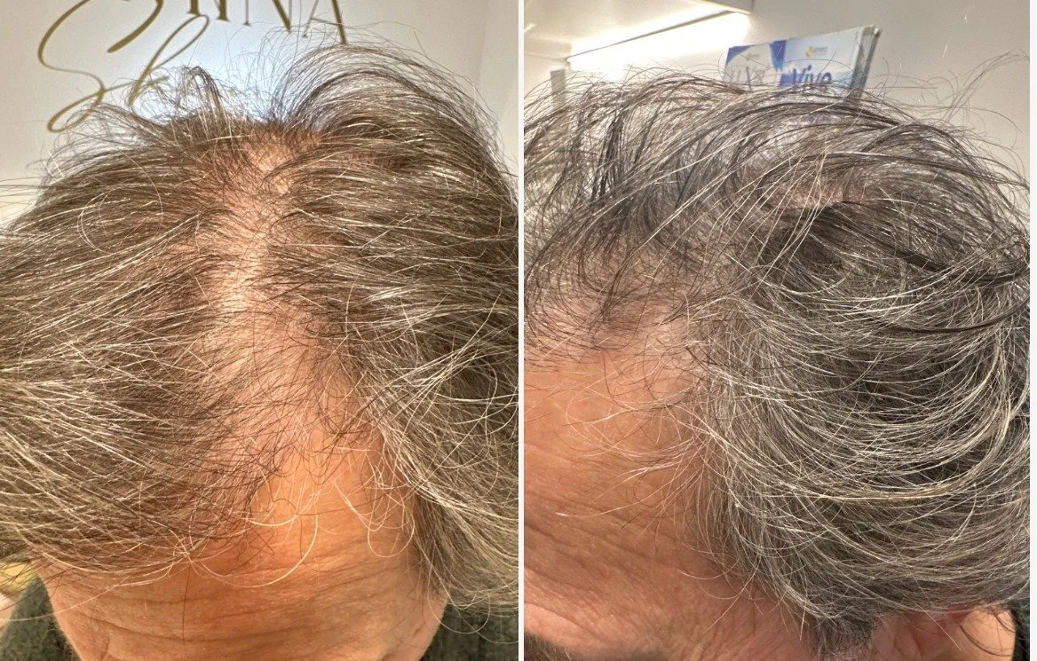 After 3 TED with TED proprietary serum
