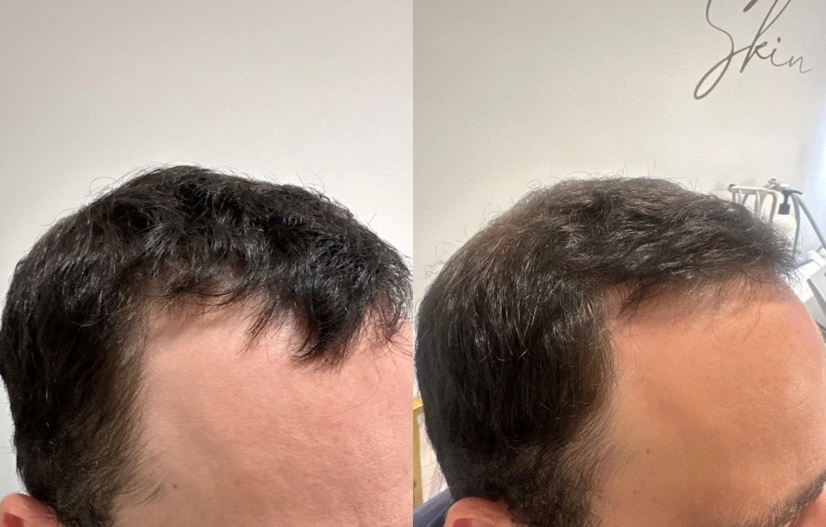 After 3 TED with TED proprietary serum + Exosomes