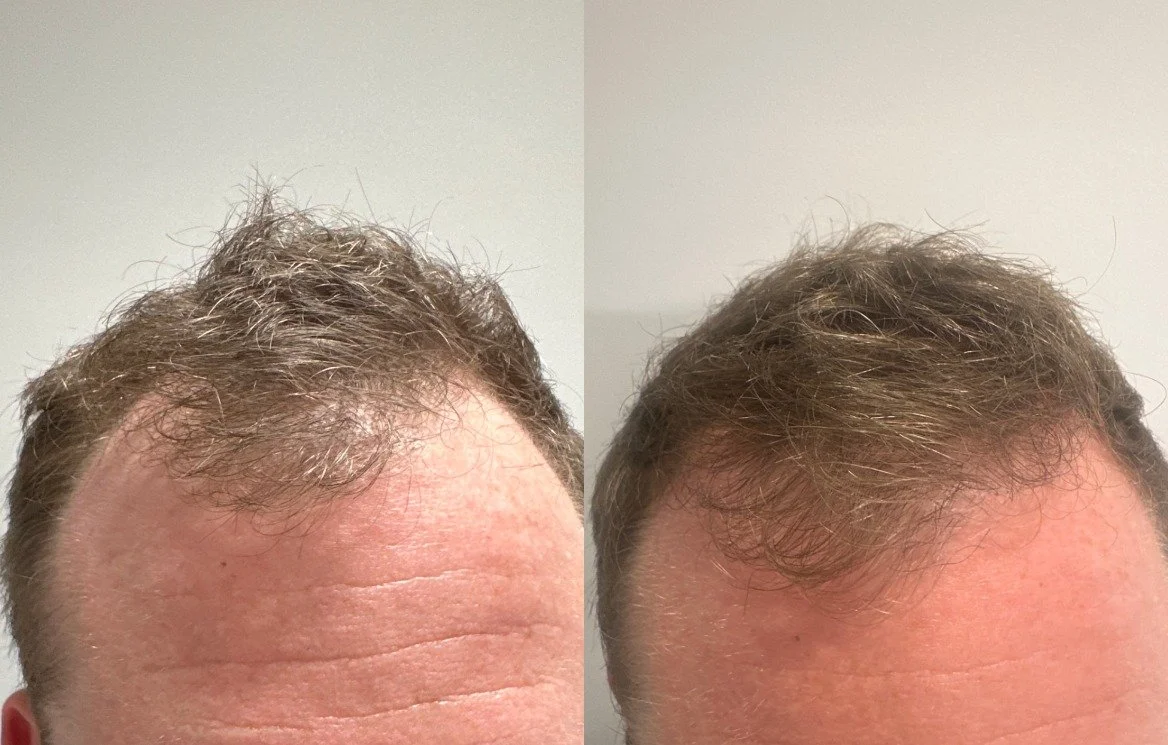 After 2 TED with TED Proprietary Serum
