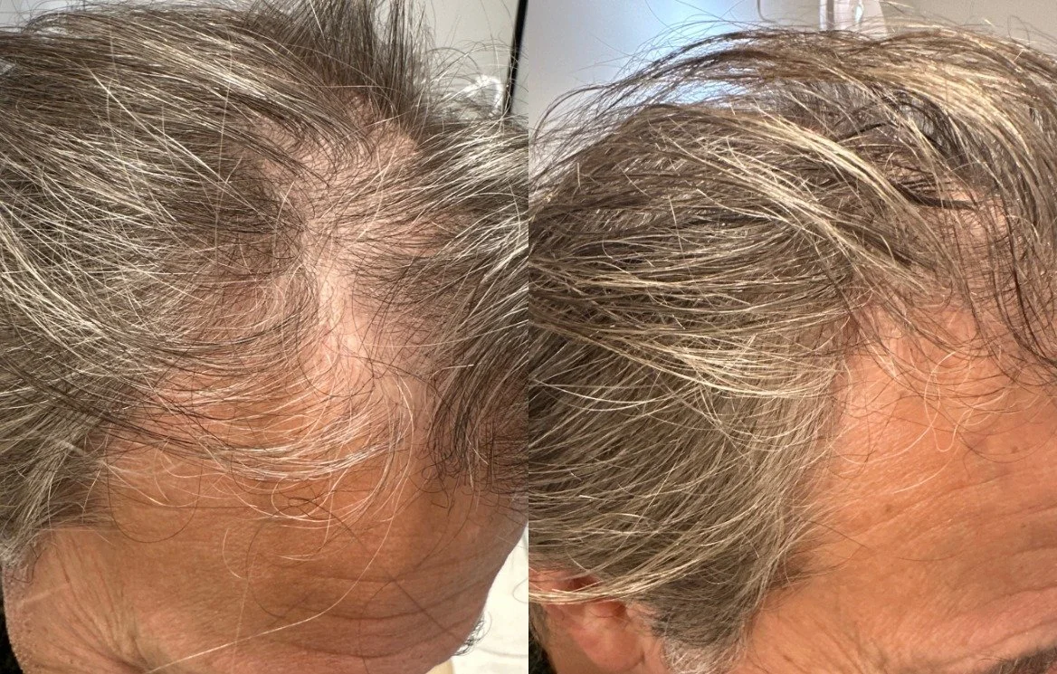 After 3 TED with TED proprietary serum