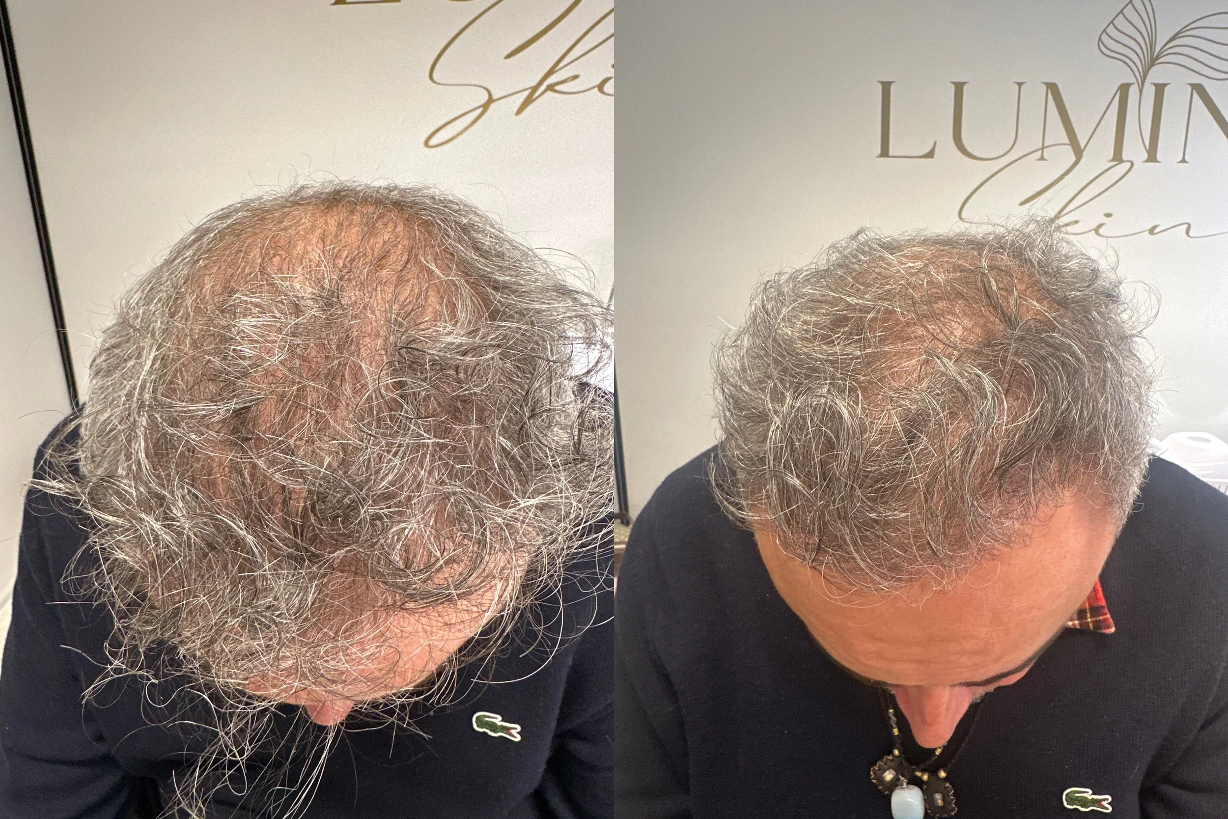 After 1 TED with TED proprietary serum
