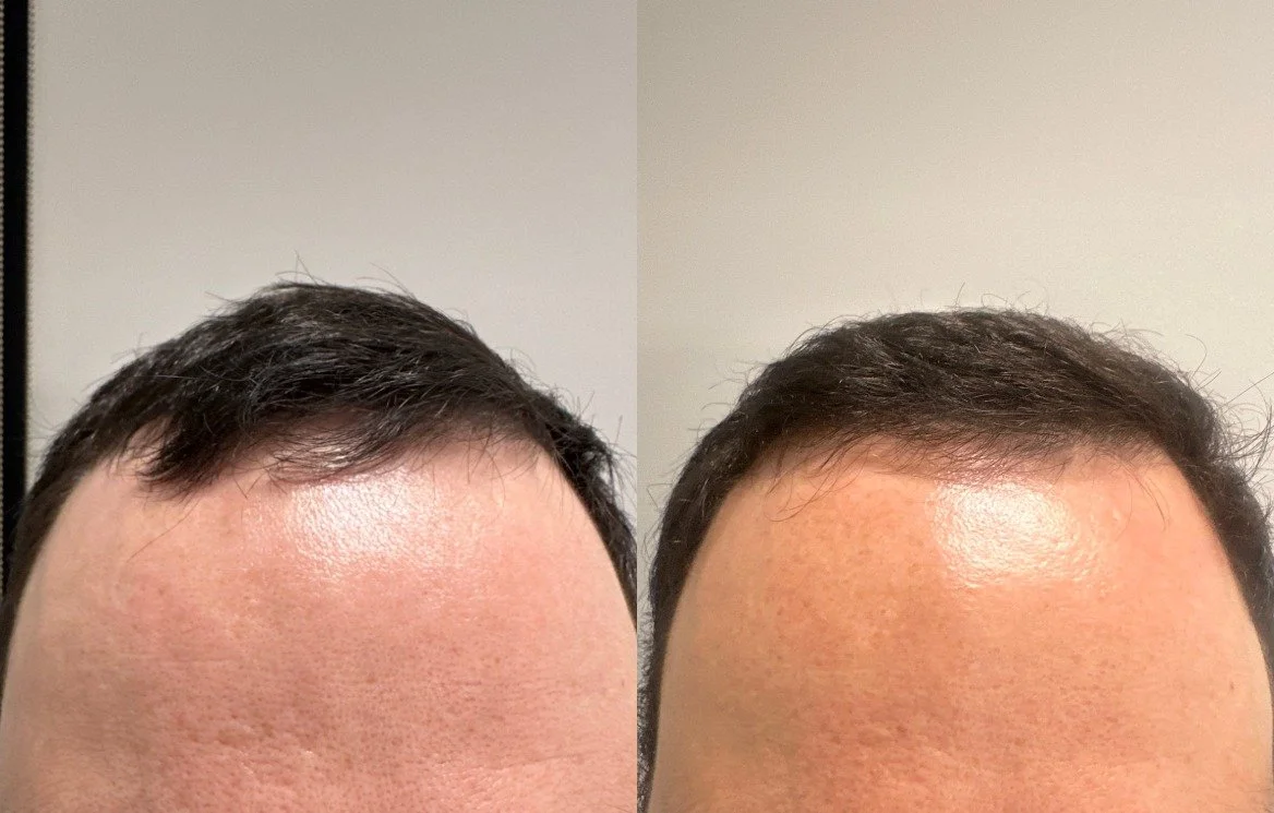 After 3 TED with TED proprietary serum + Exosomes