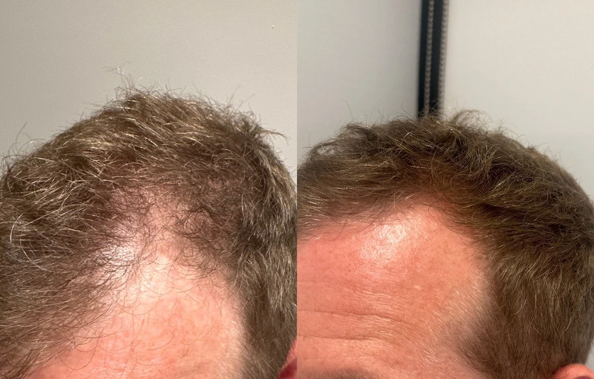 After 2 TED with TED Proprietary Serum