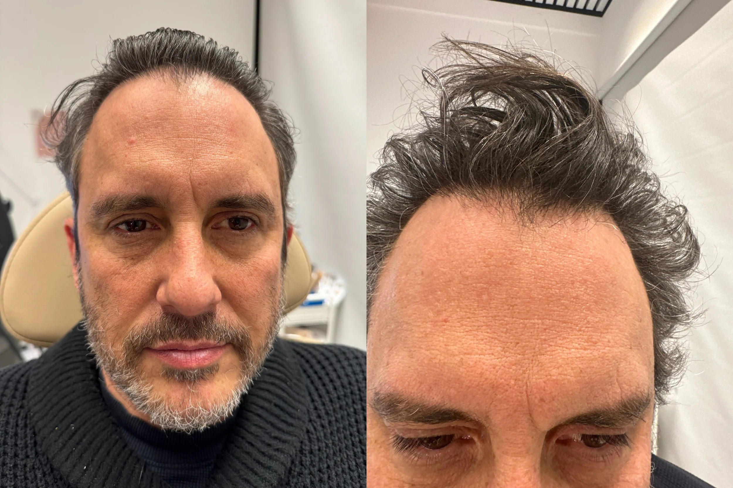 After 3 TED with TED Proprietary Serum