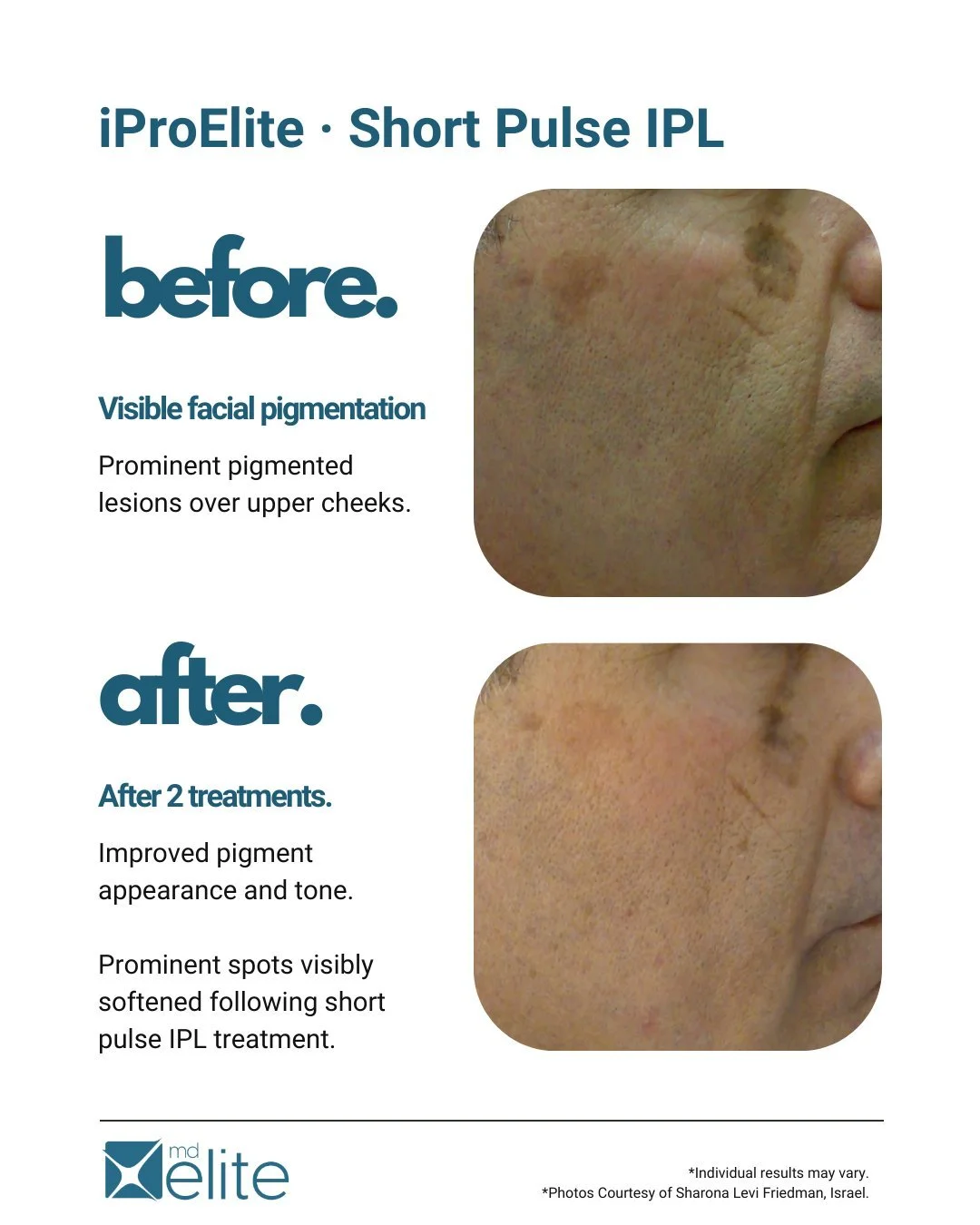 After 2 treatments with Short Pulse IPL, this patient showed visible improvement in pigmentation and overall tone.

Protocol used:
Short Pulse IPL | Fluence: 21.8 J/cm&sup2; | Single Mode | 3 consecutive pulses applied to prominent spots | Post-care: