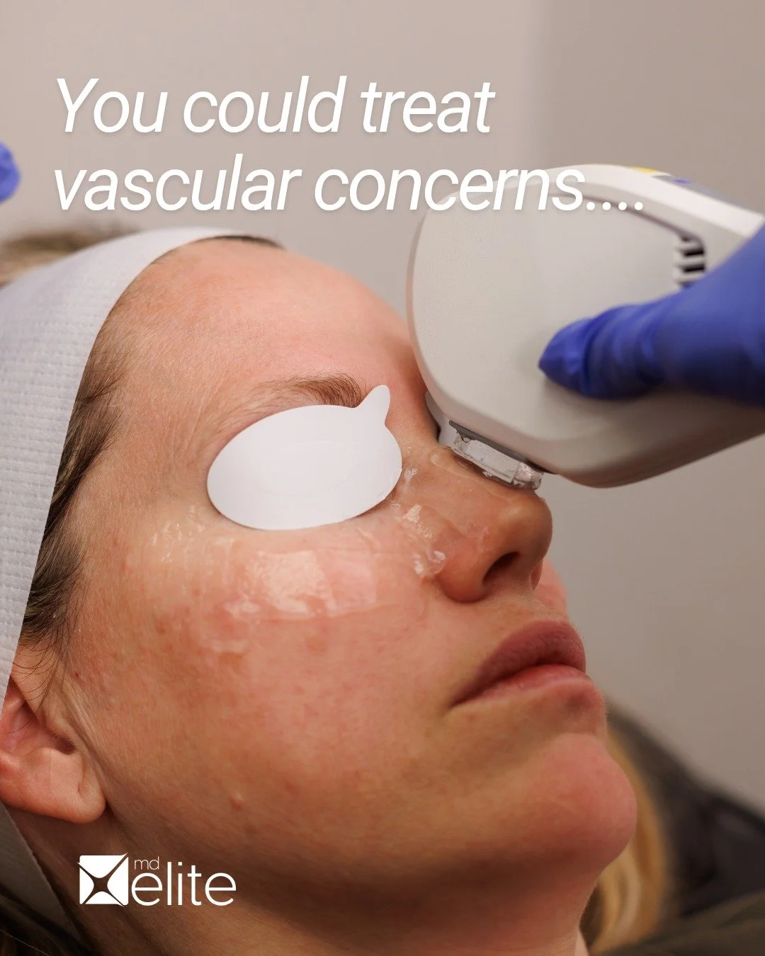 You could treat vascular concerns.
You could improve skin texture.
You could address laxity.

Or you COULD DO ALL THREE.  With ONE platform.

iProElite was built as a multi-modality system &mdash; combining IPL, Diamond E-360 exfoliation, and Micro-F