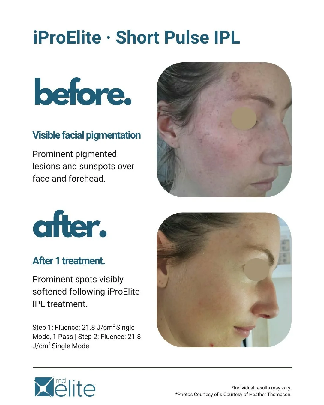 Most IPL systems rely on increasing energy to compensate for loss at the surface.

That&rsquo;s not the only way.

When energy is delivered more efficiently to the target, you don&rsquo;t have to chase higher fluence to see change.

1 treatment. Visi