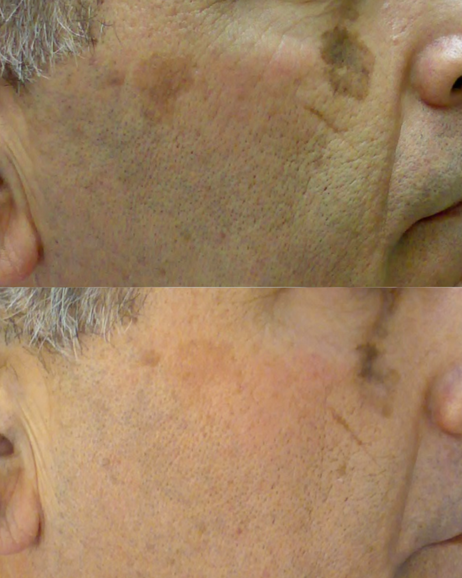 Protocol: Eleo IPL | Fluence: 21.8 J/cm² | Single Mode | 3 consecutive pulses applied to prominent spots
