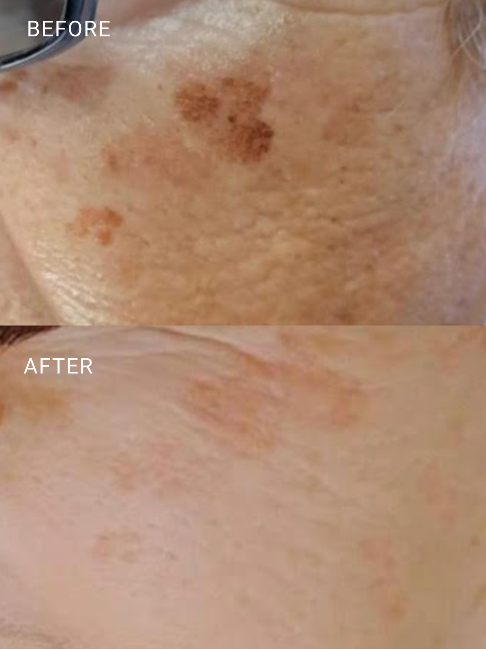 Eleo IPL with the iProElite clearing sunspots and pigmentation