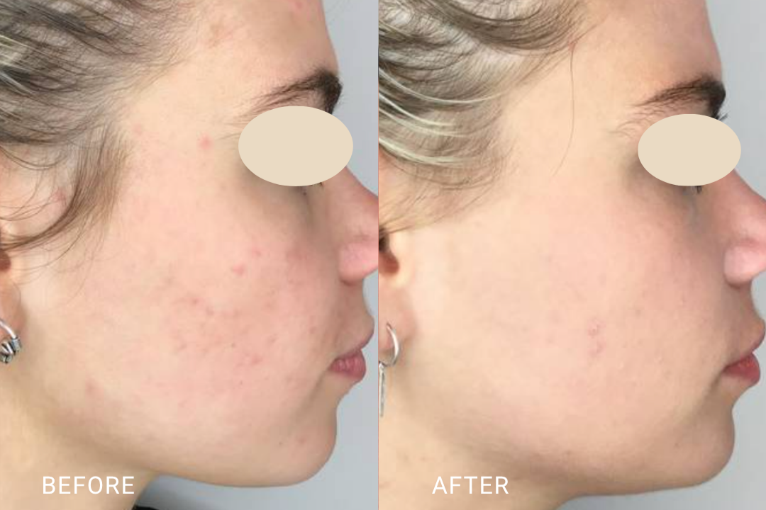 IPL short pulse on the iProElite improving skin clarity and reducing visible acne.