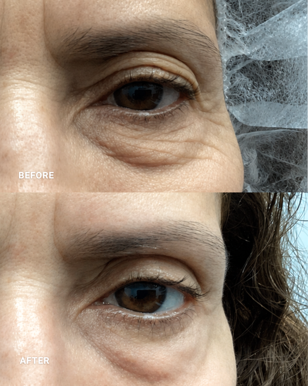 MICRO-FOCUSED RF | OCULIFT : 
Firms and tightens the upper and lower eye area while softening the appearance of fine lines and laxity
