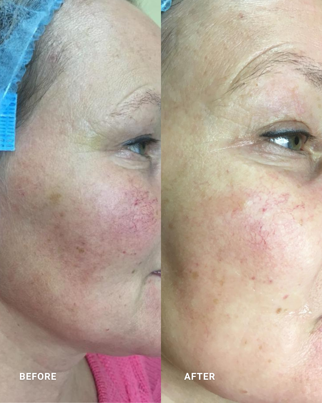 ELEO IPL | VASCULAR :
Targets visible vascularity and redness to create a clearer, more even-looking complexion.