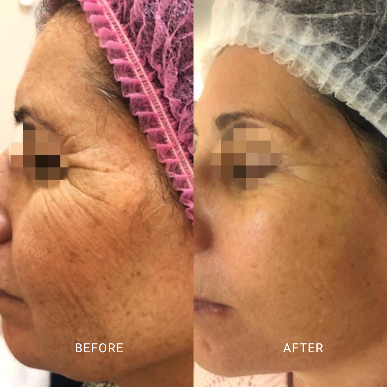 Pigmentation Therapy