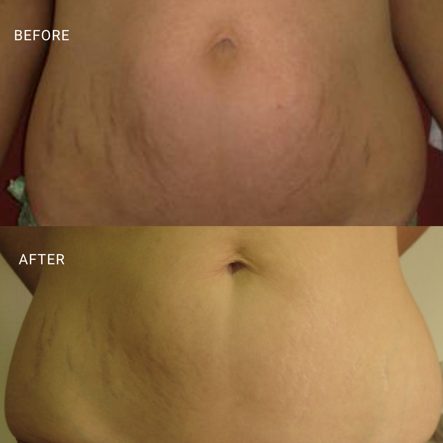 Improved skin tone and reduced laxity in the abdomen, smoother, more even texture post-treatment.

*results vary