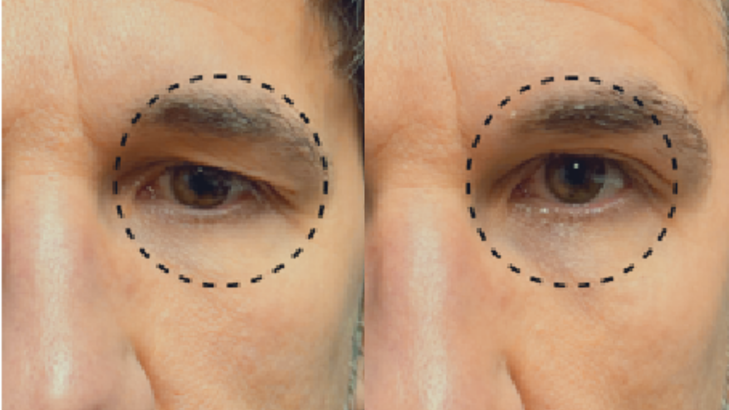 Close-up of a person's eye with dotted circle around it, showing a before and after comparison.