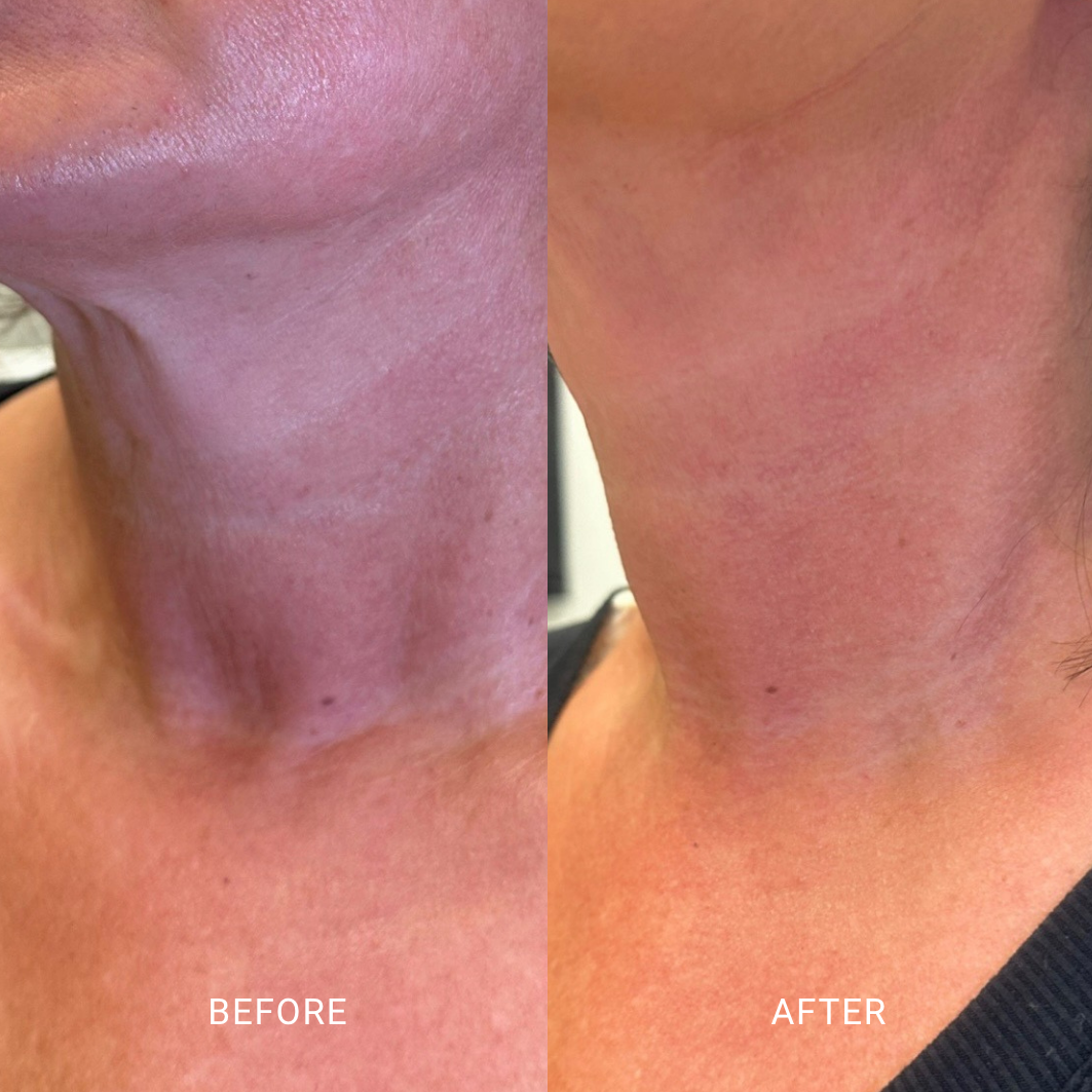 Visible tightening and improved definition in the neck for smoother, firmer skin after treatment.

*results vary