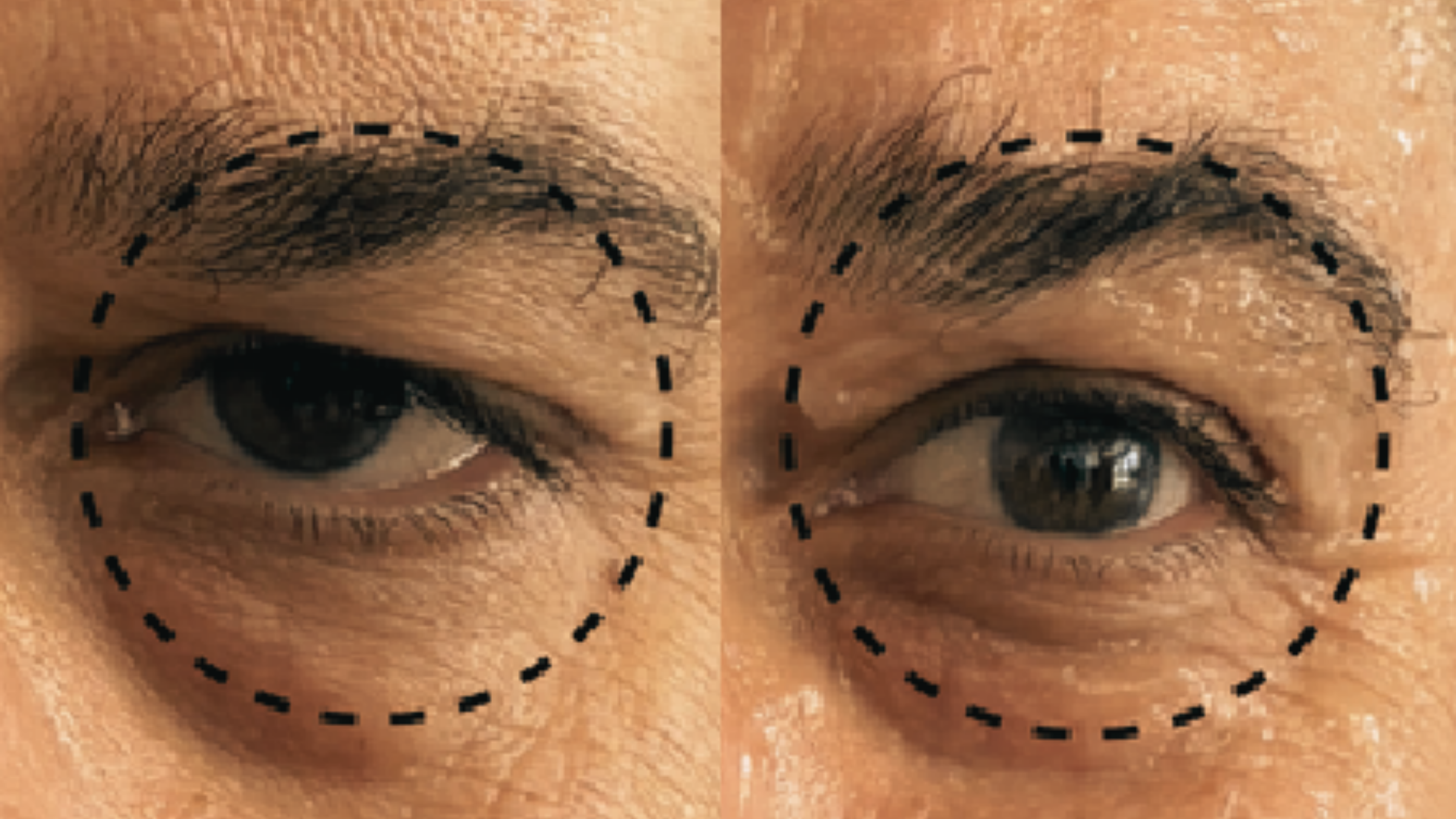 Close-up of a person's eye with a black dashed circle around the eye area, showing a comparison before and after a cosmetic procedure, with the right side appearing more lifted and smooth.
