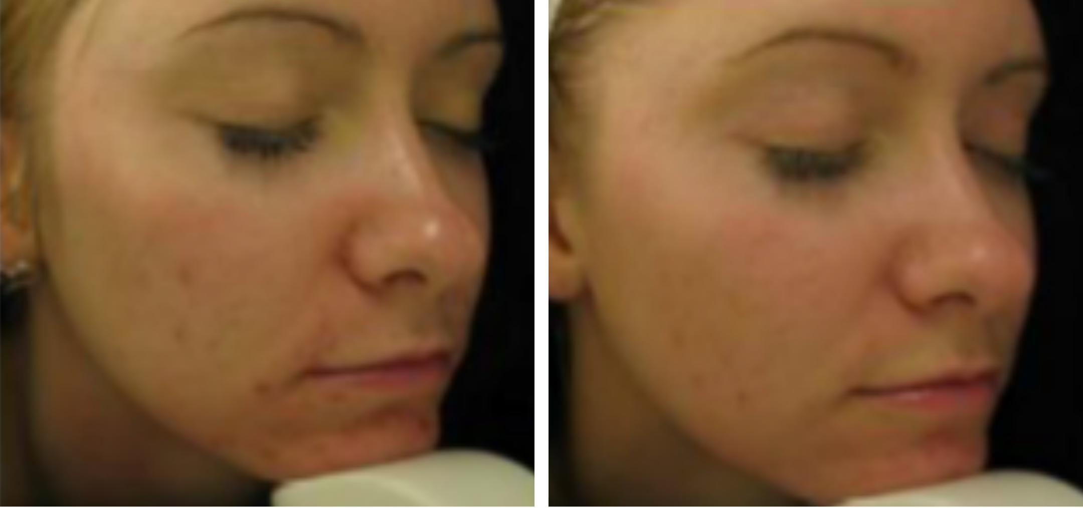 Close-up of a woman's face before and after skin treatment, showcasing clearer complexion in the second image.